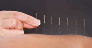 Abnehmen dank Akupunktur